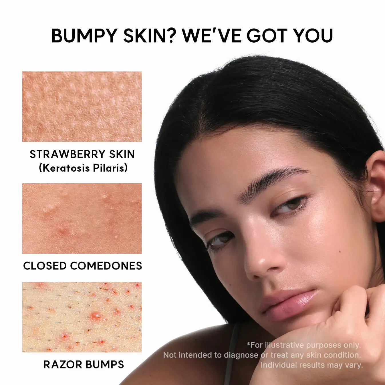 Woman with bumpy skin and images of strawberry skin, closed comedones, and razor bumps.