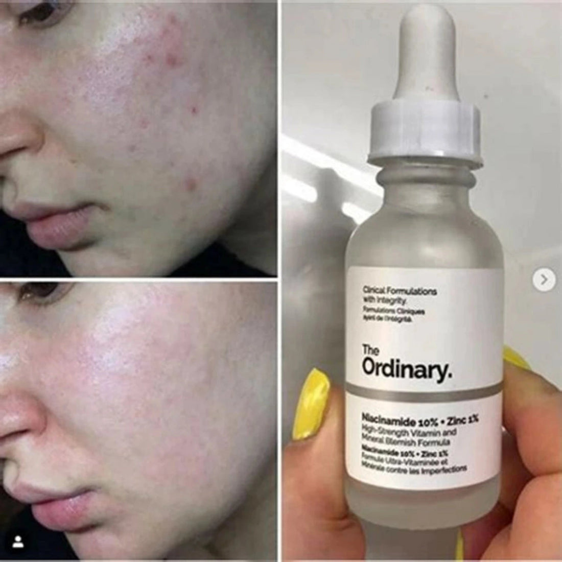 The Ordinary Niacinamide 10% + Zinc 1% 30ml - MANSH